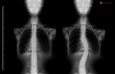 Best Ergonomic Chairs for Scoliosis: Comfort & Support Guide